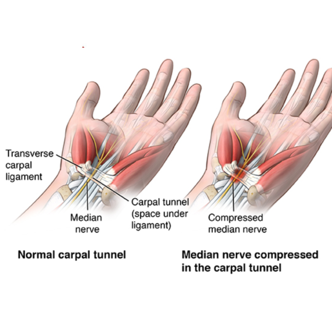 Relief for carpal tunnel: Aspire physiotherapy’s expertise